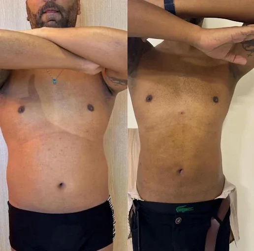 Antes e depois de paciente — abdômen e tórax masculino
