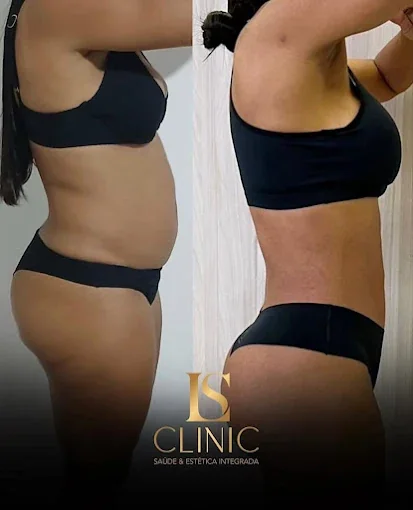Antes e depois de paciente — contorno corporal em vista lateral