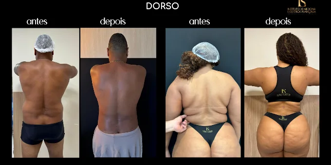 Antes e depois de dois pacientes — região do dorso